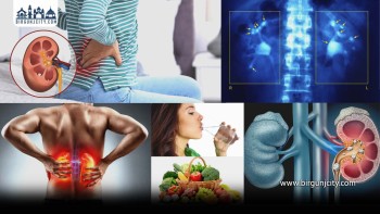 गर्मीमा मिर्गौलाको पत्थरी बढ्ने, जोखिम र बच्ने उपाय